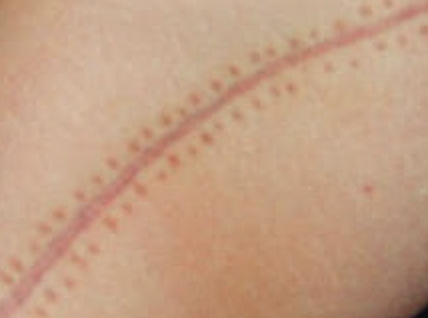 Me operan de Apendicitis