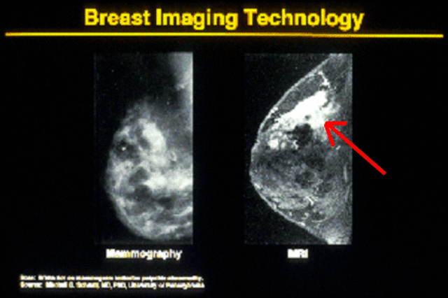 Breast Cancer - Mammogram