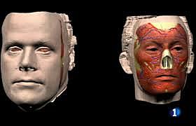 Transplante total de cara