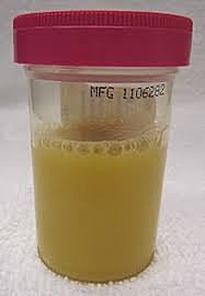 A Sample Of Anna’s Urine As Sent To The Laboratory To Identify The Exact Pathogen Responsible For The Infection.