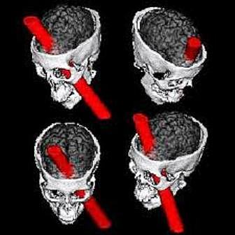 Barra de hierro atraviesa su cabeza y sobrevivió