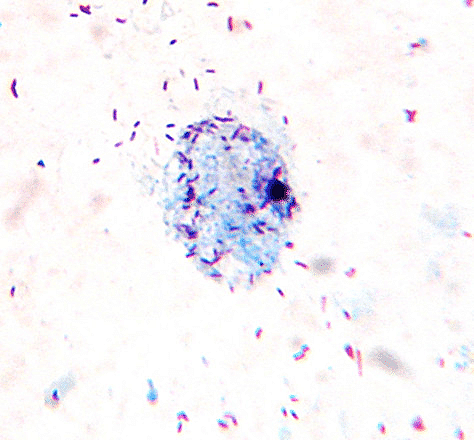 La fiebre manchada de las Montañas Rocosas