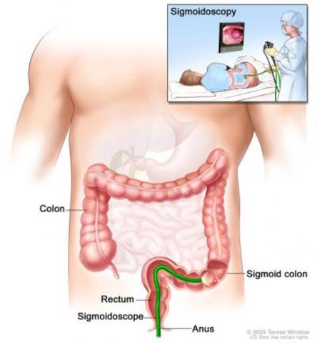 Colorectal Cancer and Polyps - Sigmoidoscopy