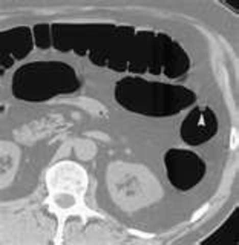 Colorectal Cancer and Polyps - CT colonography