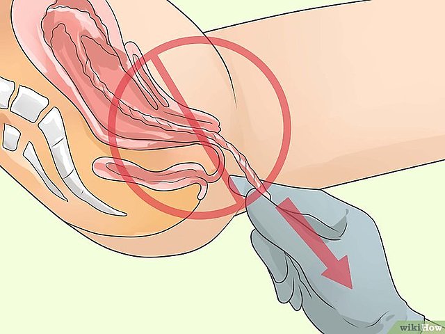 El Parto y sus Etapas (3 etapa)