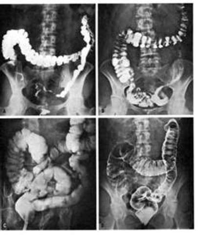Colorectal Cancer and Polyps - Double Contrast Barium Enema