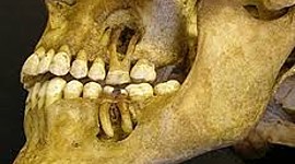 Timeline: Historia del Níquel Titanio en Endodoncia