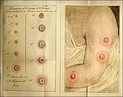 Inoculacion de Viruela