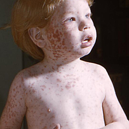 Vacuna conra la rubeola