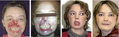 First Partial Face Transplant