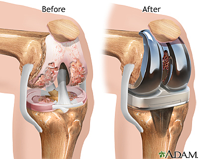 Inspiration of the Development of Knee Replacements