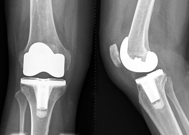First Total Knee Replacement