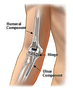 Dr. Dee Reported the First Functionally Designed Total Elbow Arthoplasty (TEA)