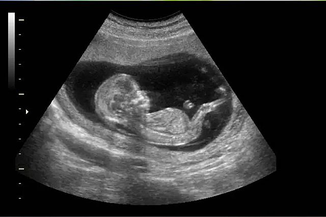 Ultrasounds