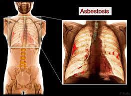 Asbesto