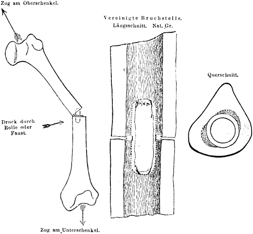 Germania - Inserti in avorio