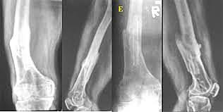 Hoglund (USA) - Osso autologo