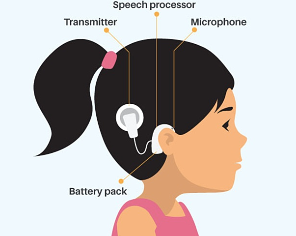 Cochlear Implants Stir Controversy
