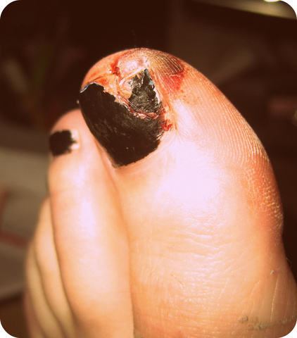 Windstorm leads to toe injury