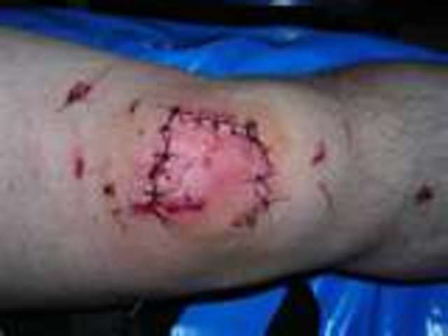 I wrecked a bike and my sister had to get stiches