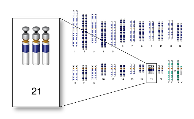 Descubrimiento de la trisomía 21