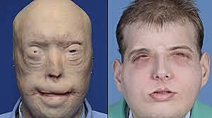 Transplante Total de Cara