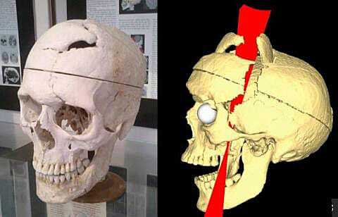 Barra de hierro atraviesa su cabeza y sobrevivió