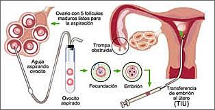 Transferencia intrafalopiana de gametas