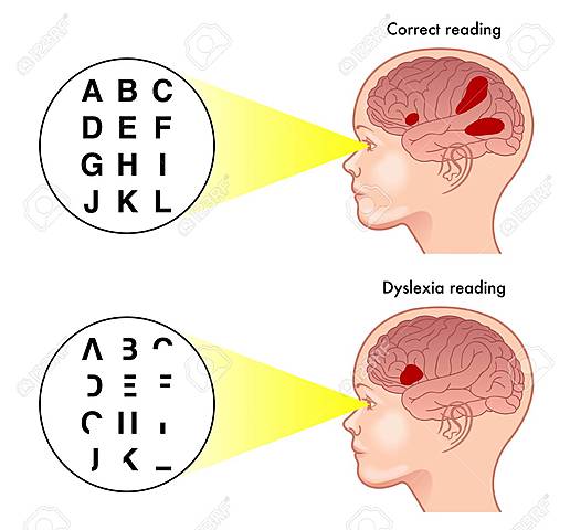 Se describen casos similares entorno a la dislexia
