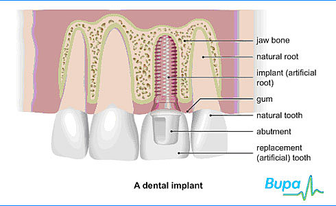 Implantes sintéticos
