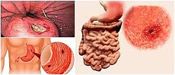 La causante a úlceras estomacales