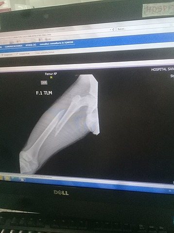 Me fracturo mi pierna