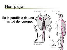 Hemiplejia Izquierda