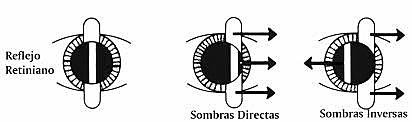 La tecnica del Retinoscopio