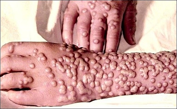 Febre Amarela e Varíola