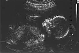 An Ultrasound-In the womb