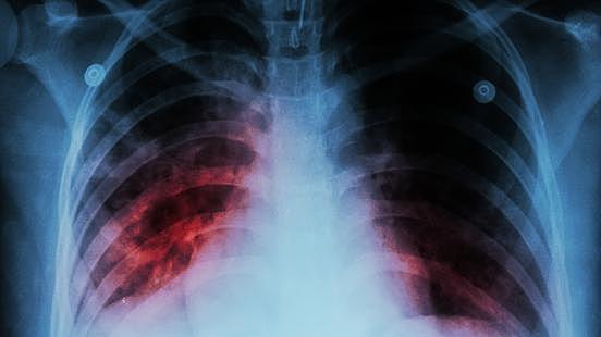 TUBERCULOSIS