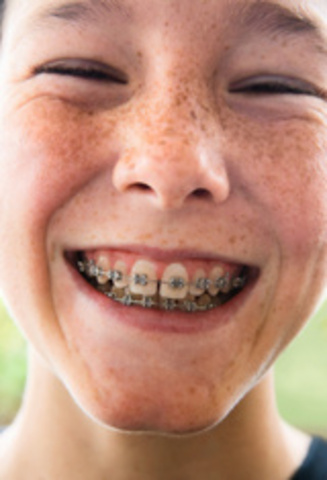 I got my braces on:(