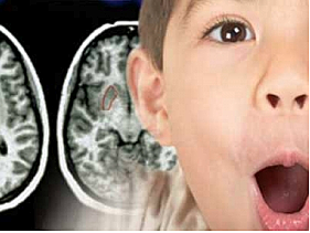 Retraso mental de DSM IV