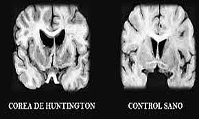 George Huntington medico estadounidense determina los síntomas de una corea hereditaria