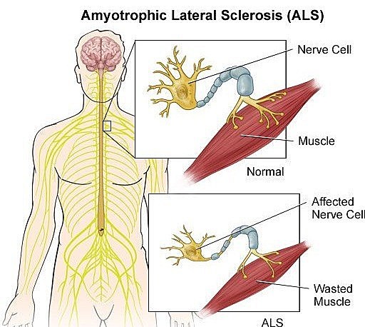 Jean-Martin Charcot neurólogo francés médico especializado en enfermedades nerviosas, pionero de la psicopatología es el fundador de la neurología moderna