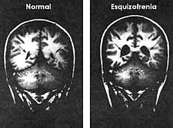 Eugen Bleuler paiquiatra suizo determina el término esquizofrenia y autismo