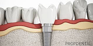 Estudio osteointegración
