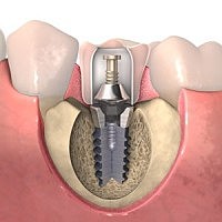 Implantología dental