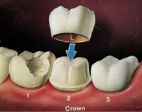 A Jacket Crown