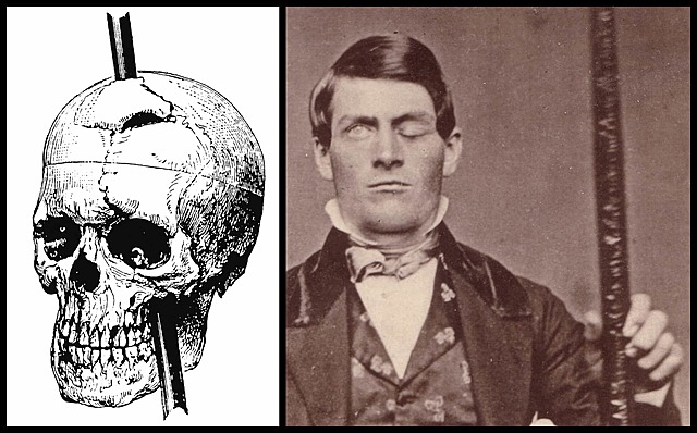 Phineas Gage y el enigma del córtex prefrontal