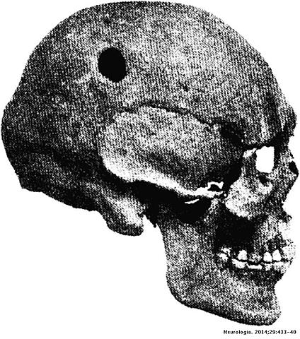 Trepanación
