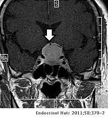 Me internan y encuentran un quiste en el cerebro