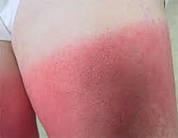 Comienzan primeros síntomas de fotosencibilidad y reacciones alergicas anafilacticas