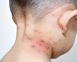 Erradicación de Viruela en México.